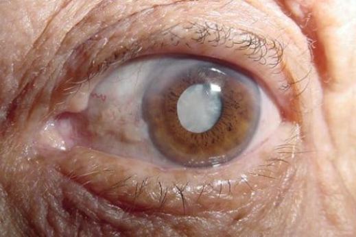SESAU anuncia realização de cirurgias de catarata